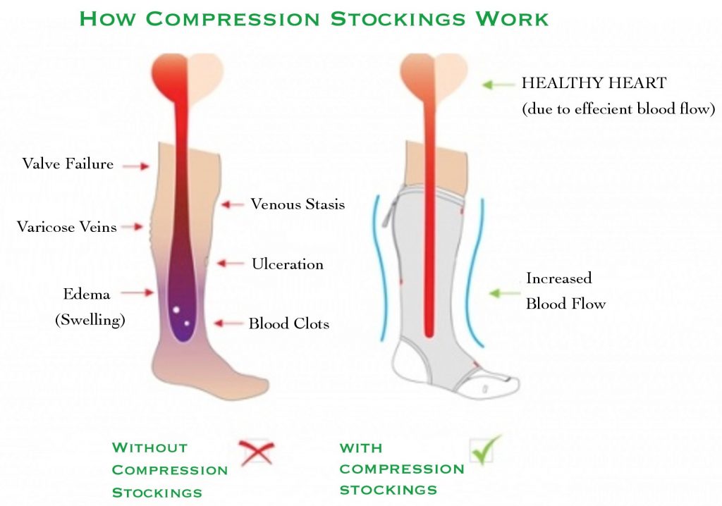 Varicose Vein Stockings - TrueCare 